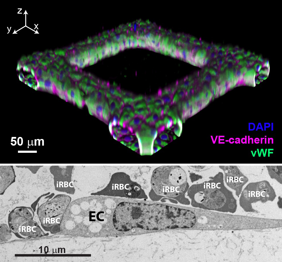 Figure 1: Top: 3D reconstruction of 3D brain microvessels. Bottom: Ultrastructural imaging showing multiple P. falciparum-iRBCs binding to a primary human brain microvascular endothelial cell (EC) within the 3D brain microvessels. The major focus of the lab is to understand how P. falciparum­ mediates brain vascular damage.