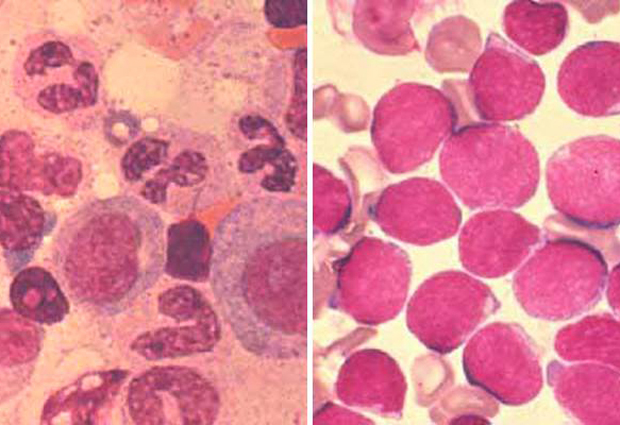 Healthy bone marrow (left) vs. bone marrow of leukaemia patient (right). IMAGE: MEDIZINISCHEN HOCHSCHULE HANNOVER