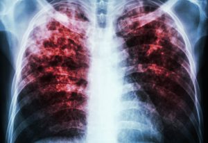 Tuberculosis – caused by Mycobacterium tuberculosis – is a potentially fatal contagious disease that can affect almost any part of the body but is mainly an infection of the lungs