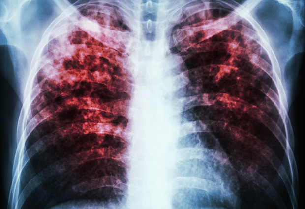 Tuberculosis – caused by Mycobacterium tuberculosis – is a potentially fatal contagious disease that can affect almost any part of the body but is mainly an infection of the lungs