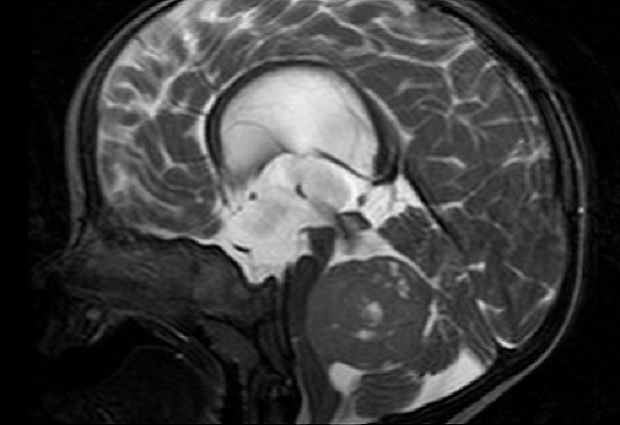 MRI image of a medulloblastoma
