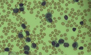 Leukaemia blood cells
