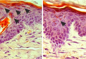 Mouse skin samples of the rare genetic skin disease amyloidosis, before light treatment (left) and after treatment (right). The arrows indicate aggregates of debris, which cause the skin to become rough and uncomfortable. Upon treatment these aggregates are reduced, allowing the skin to heal. IMAGES: Paul Heppenstall and Linda Nocchi / EMBL