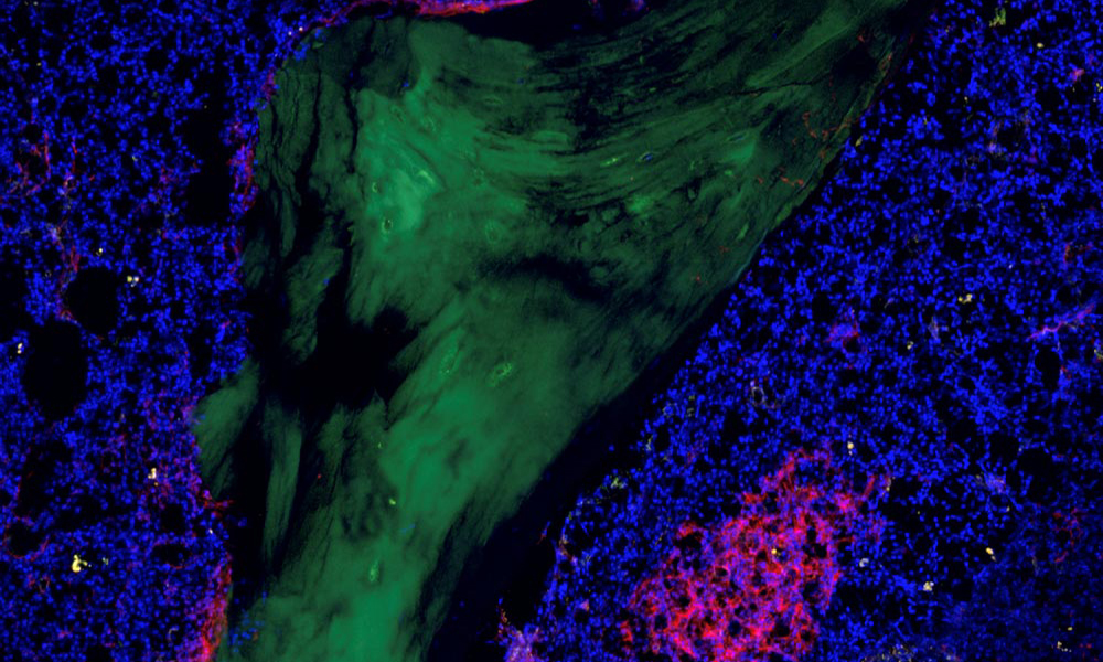 Leukaemia stem cells are located in a patient’s bone marrow (shown here in blue) in the so-called stem cell niche. The green structure is the bone itself. Credit: Dr. Raphael Lutz, Haas Lab