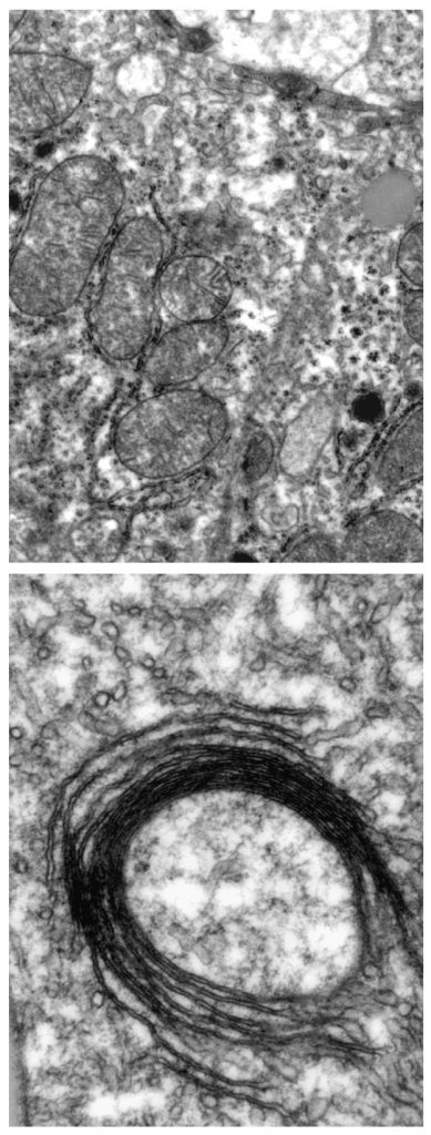 These electron microscopy images show mitochondria in a normal cell (top) and a close-up of a mitochondrion with structural defects, in a cell that cannot produce IRPs (bottom).