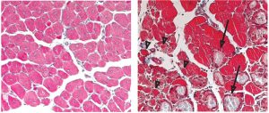 This microscopy image, taken ten days after injury, shows that the muscle fibres of normal mice (left) had re-grown, while in mice which couldn’t boost C/EBPβ production (right) there were still many fibres that had not regenerated (arrowheads), and the tissue had a number of scars (arrows).