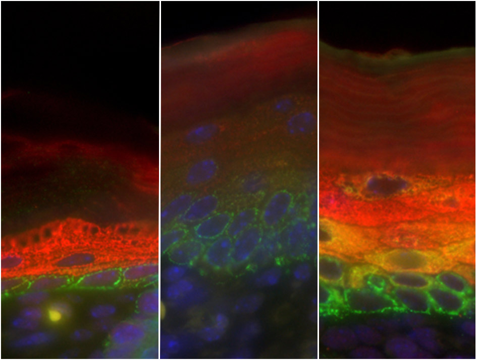 In normal skin (left), the stem cells at the base, shown in green, differentiate into skin cells, shown in red. In mice whose skin has neither C/EBPα nor C/EBPβ (middle), this differentiation is blocked: green-labeled stem cells appear in upper layers of skin, and there are no differentiated skin cells (no red staining). This also happens at the initial stages of basal cell carcinomas. In skin where C/EBPα is present but has lost its capacity to interact with E2F, a molecule that regulates the cell cycle (right), skin cells start differentiating abnormally, before they have properly exited the stem cell ‘program’ (yellow/orange). This is similar to what is observed in the initial stages of squamous cell carcinomas, a more aggressive and invasive skin tumour.