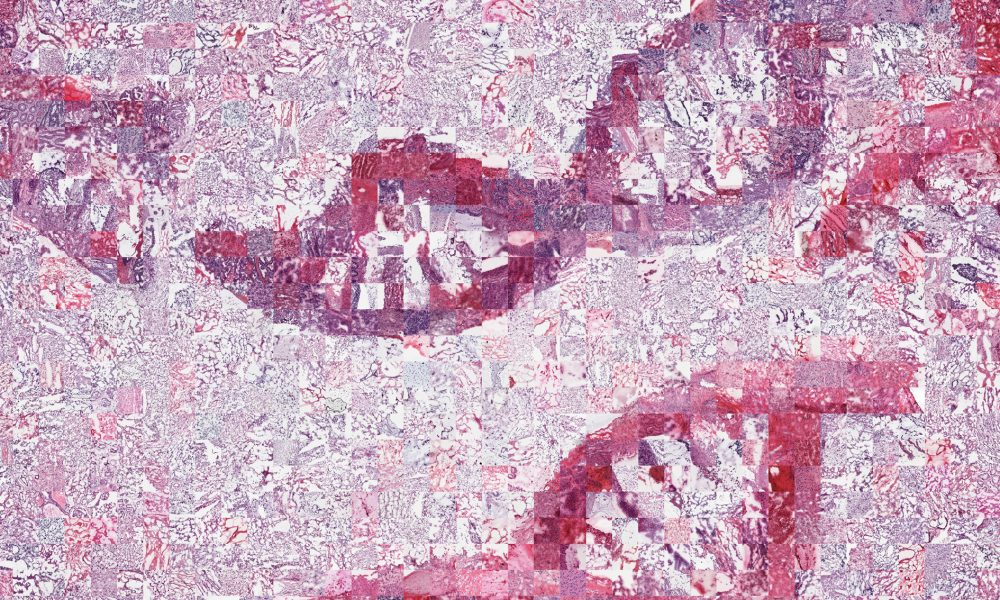 Mosaic of microscopy images of tumour, forming two broken DNA molecules