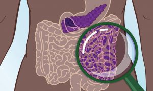 Image of a body in which we can see the pancreas and the gut. A magnification in the gut area shows microorganisms that could give clues to detect early stages of pancreatic cancer